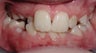 Severe crowding and unilateral crsosbite