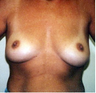 Breast Implants