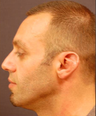 Otoplasty