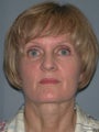 Neck Lift