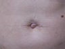 Umbilicoplasty to remove lose skin around belly button