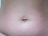 Umbilicoplasty to remove lose skin around belly button