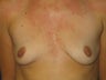 Breast Augmentation