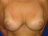 Breast lift