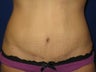 Tummy tuck