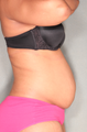 smartLipo™ 