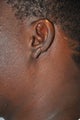 25 year old black male with a recurrent keloid of the ear