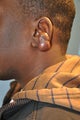 25 year old black male with a recurrent keloid of the ear
