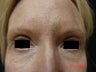 Fraxel Laser