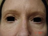 Fraxel Laser