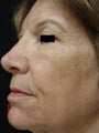 Fraxel Repair