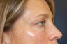 Juvederm
