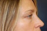 Juvederm