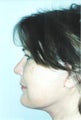 Facelift