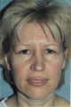 Brow lift