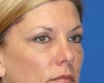 Eye Rejuvenation