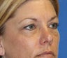 Eye Rejuvenation