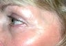 56 year old female patient 