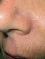 Before & After Facial Vein Treatment