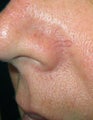 Before & After Facial Vein Treatment