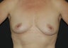 Breast Augmentation