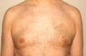 Gynecomastia and Power Assisted Liposuction