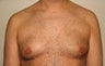 Gynecomastia and Power Assisted Liposuction