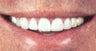 Smile Makeovers