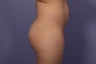 Butt augmentation