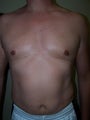 Vaser liposuction