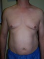 Vaser liposuction