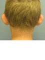 Otoplasty/Ear Surgery