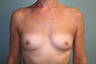40 year old female patient who received a breast augmentation with implants 