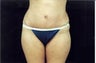 Tummy Tuck