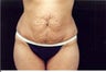 Tummy Tuck