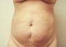 Laser Liposuction to the abdomen & flanks 