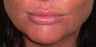This is a young woman wanted fuller lips