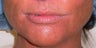 This is a young woman wanted fuller lips