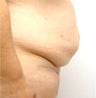 Tummy Tuck