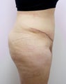 Tummy Tuck