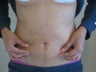 Liposuction
