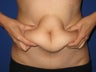 Liposuction