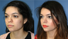 22 Year Old Female, primary Rhinoplasty