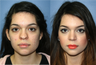 22 Year Old Female, primary Rhinoplasty