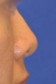 Asian Rhinoplasty
