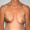 Bilateral Breast Reconstruction after Mastectomy