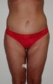 45 year old female patient 