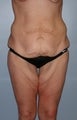45 year old female patient 