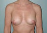 Female patient whose condition was corrected with breast implants 