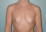 Female patient whose condition was corrected with breast implants 